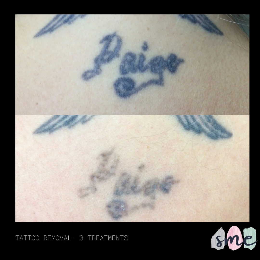 Laser Tattoo Removal