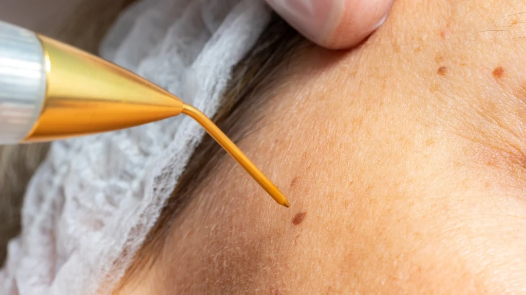 Skin Pin treatment hero image